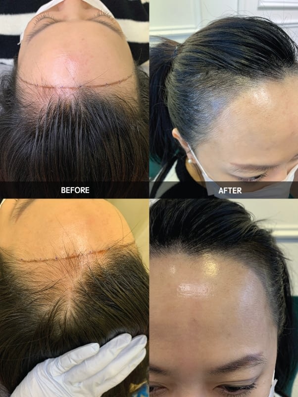 Hairline Embroidery - Semi-permanent Makeup Malaysia